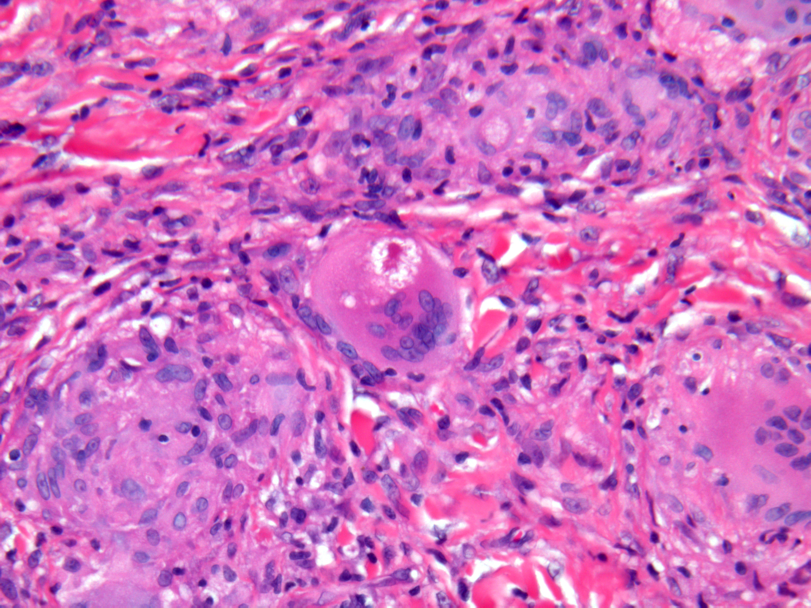 Sarcoidosis (cutaneous sarcoidosis)