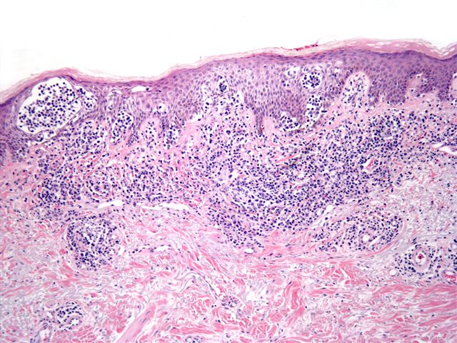 Mycosis Fungoides and Sézary Syndrome