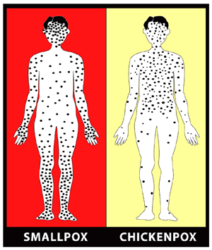 Smallpox (variola, variola major, variola minor, variola vera, alastrim