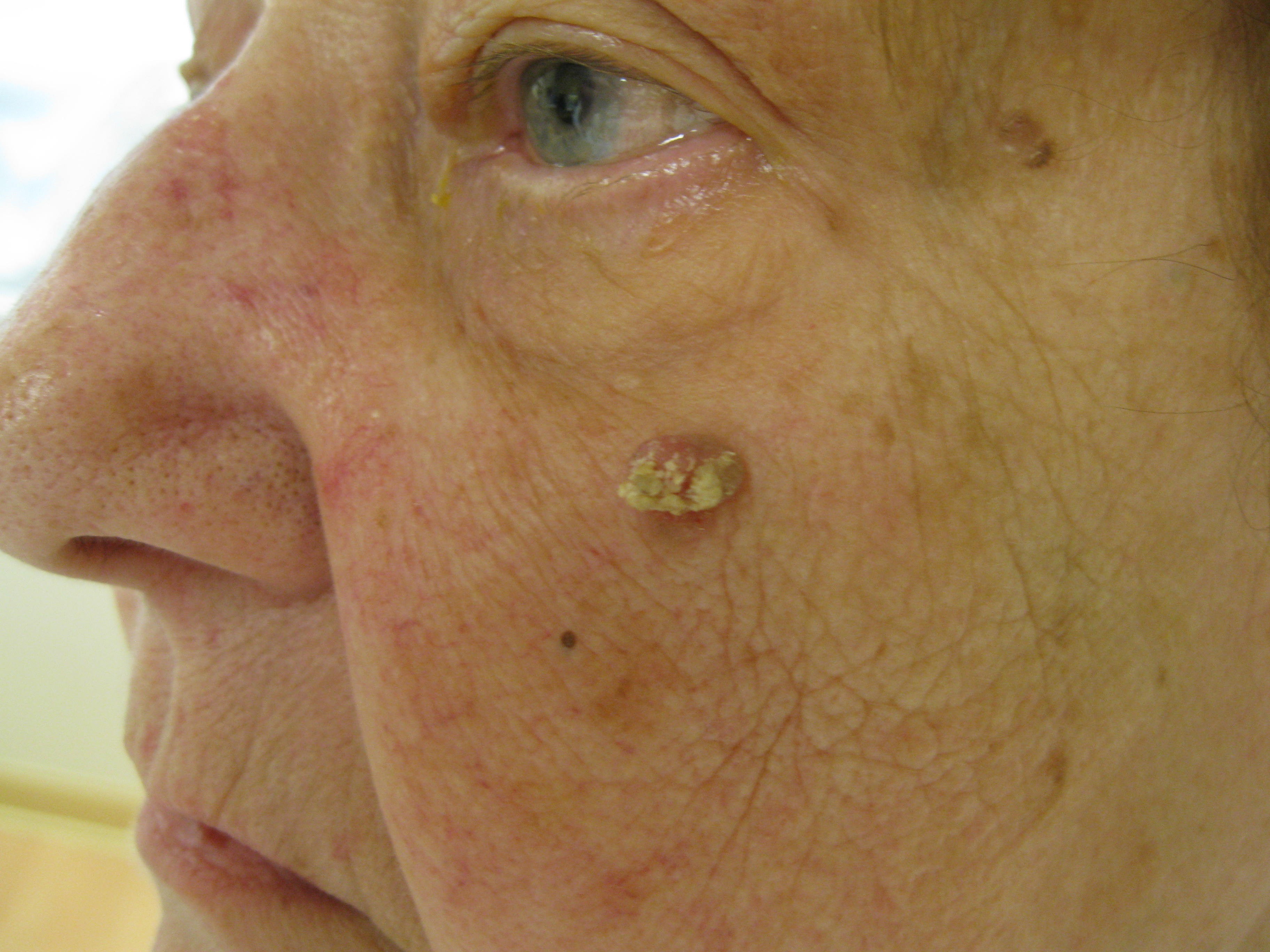 squamous-cell-carcinoma-of-the-skin