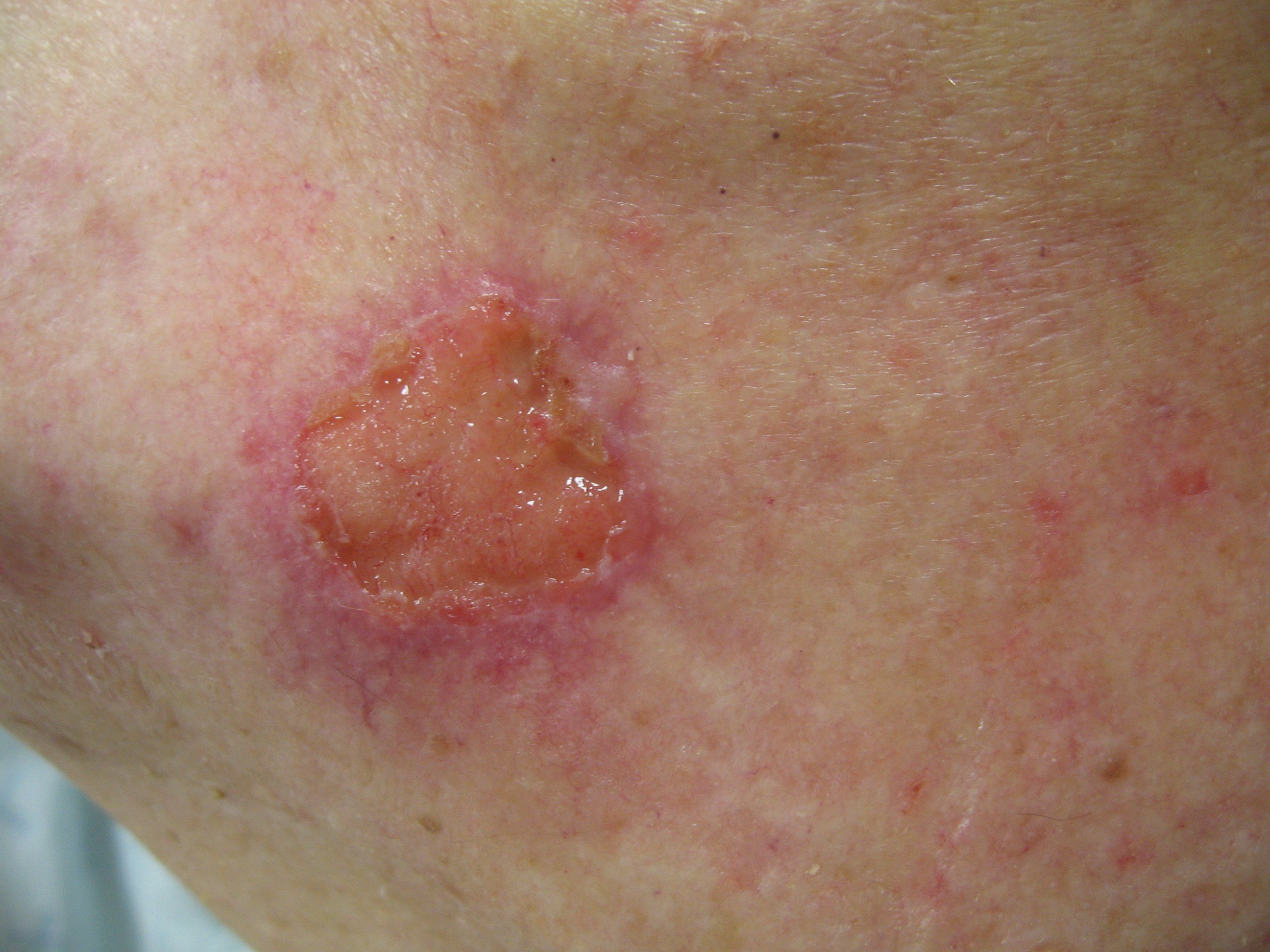 Squamous Cell Carcinoma Of The Skin 