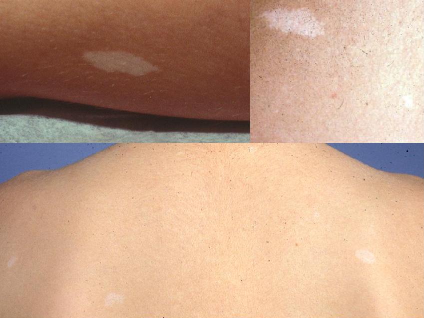 tuberous sclerosis complex Tuberous sclerosis (two-bur-uhs skluh-roh-sis), also called tuberous sclerosis complex, is an uncommon genetic disorder that causes. tuberous sclerosis complex Tuberous sclerosis (two-bur-uhs skluh-roh-sis), also called tuberous sclerosis complex, is an uncommon genetic disorder that causes.