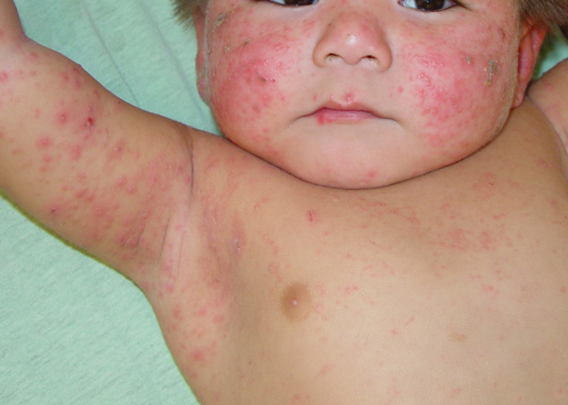 Neonatal Skin Lesions Neonatal pustular transient melanosis skin
lesions common infantile medicinenet pediatrics collection uchicago edu