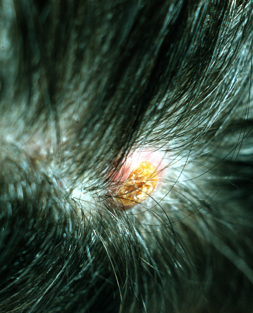 proliferating-trichilemmal-tumor-proliferating-tricholemmal-tumor