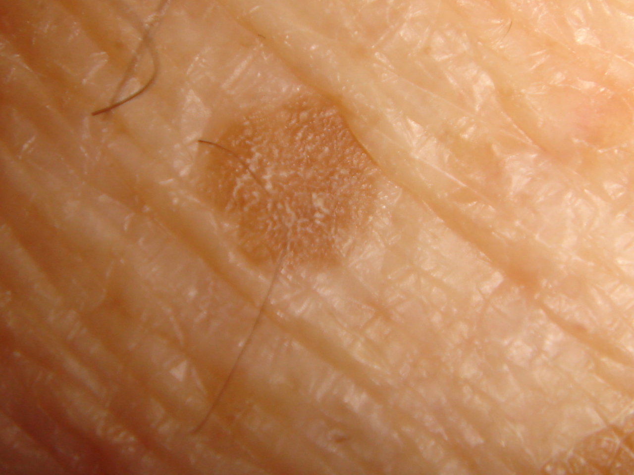 Actinic Keratosis (Solar Keratosis, Sun Spots)