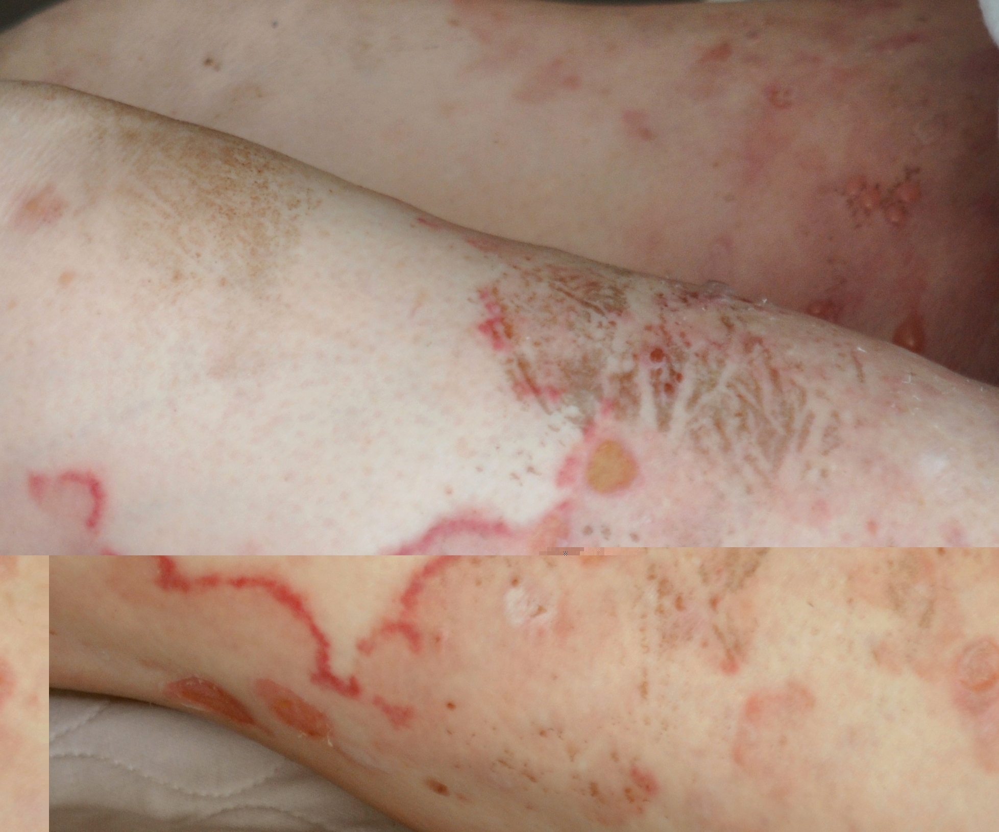 Bullous Pemphigoid Pemphigoid Gestationis Herpes Gestationis