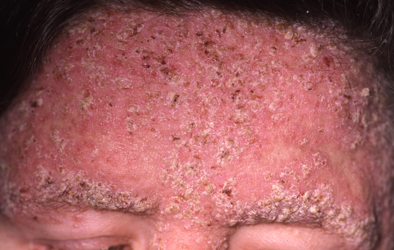 Darier's disease (Darier-White Disease, Dyskeratosis follicularis