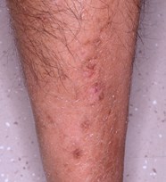 Diabetic Dermopathy Pigmented Pretibial Patches Of Diabetes Mellitus 