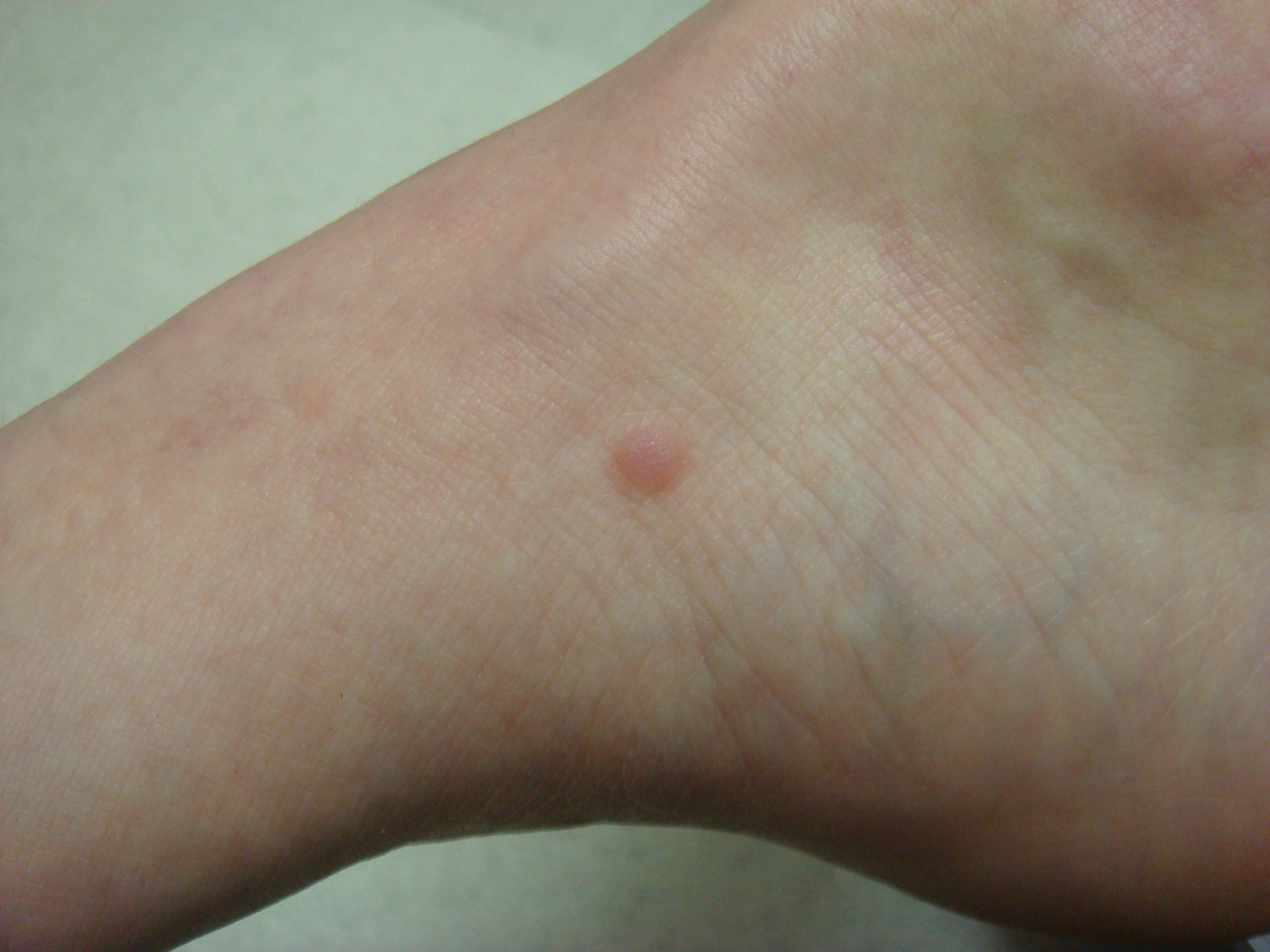 eccrine