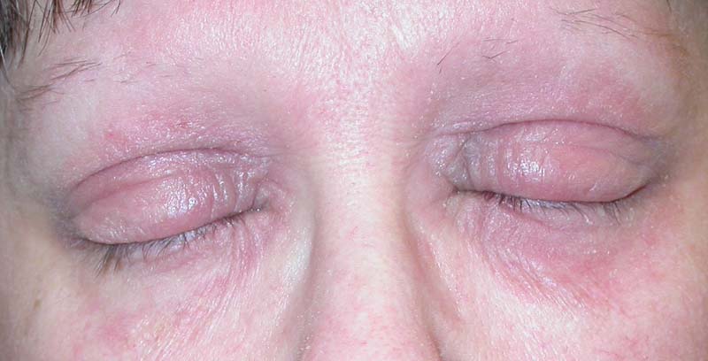 Can Allergies Cause Eczema Around Eyes