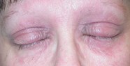 Eyelid Dermatitis xeroderma Of The Eyelids Eczema Of The Eyelids 